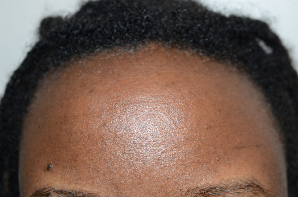 hairline advancement - patient 10531 - before 3