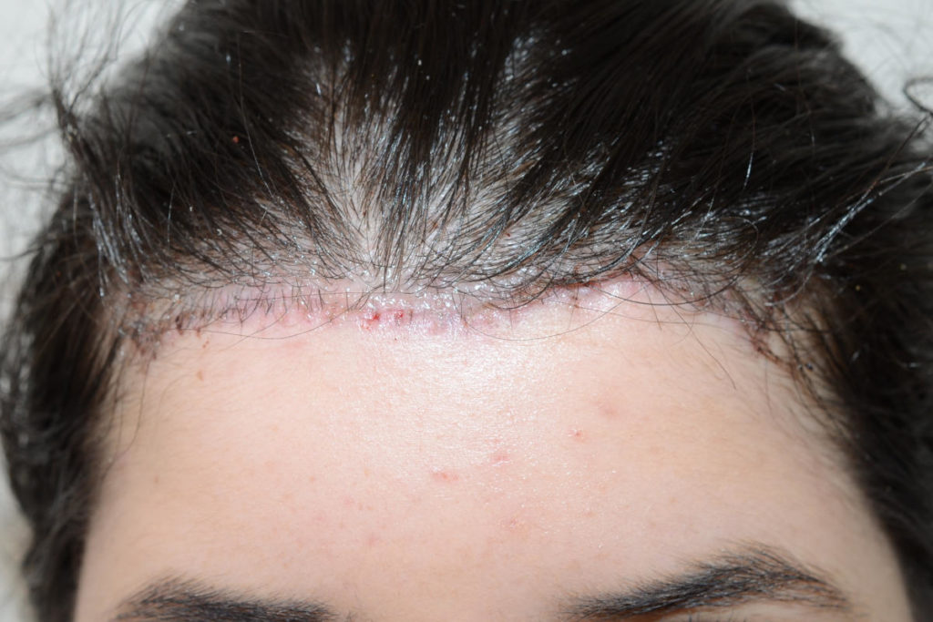 hairline advancement - patient 10607 - after 1