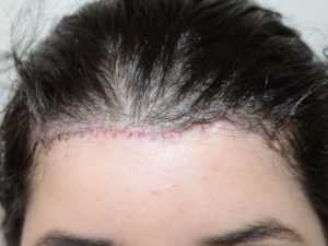  Hairline Advancement Photo - Patient 1 - After 1