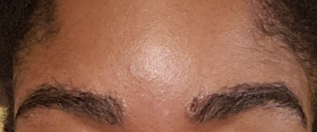 eyebrows transplant - patient 10603 - after 1