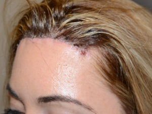  Hairline Advancement Photo - Patient 1 - After 2