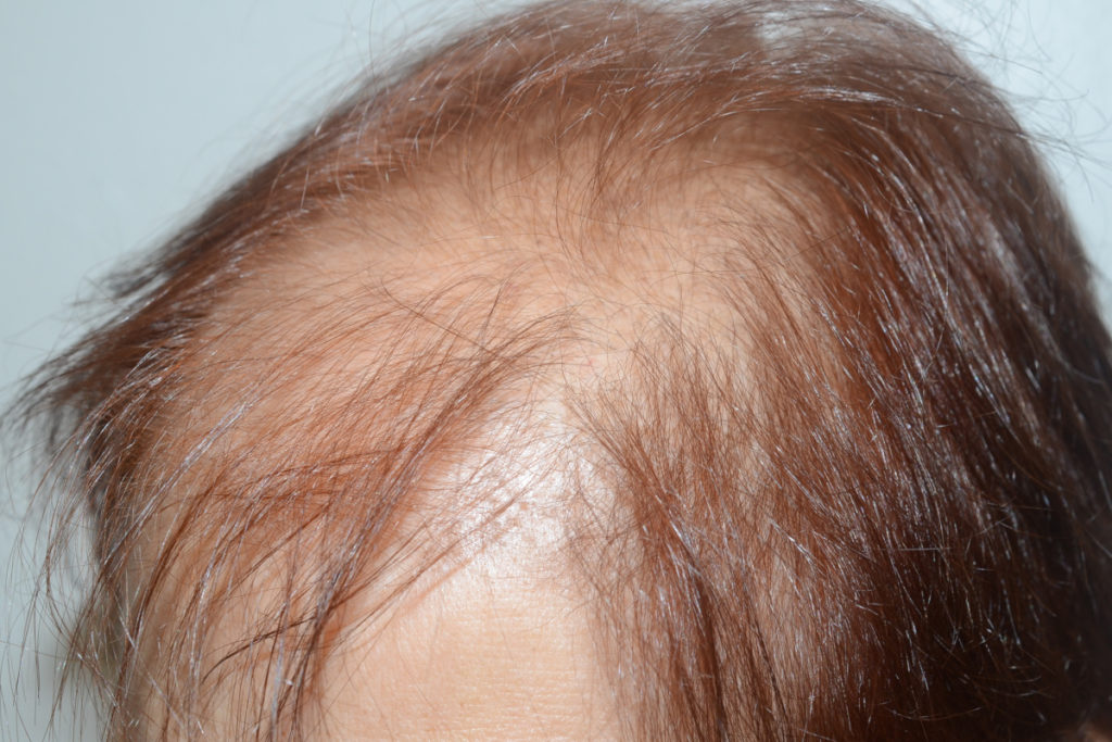 follicular unit micrografting - patient 10661 - before 2