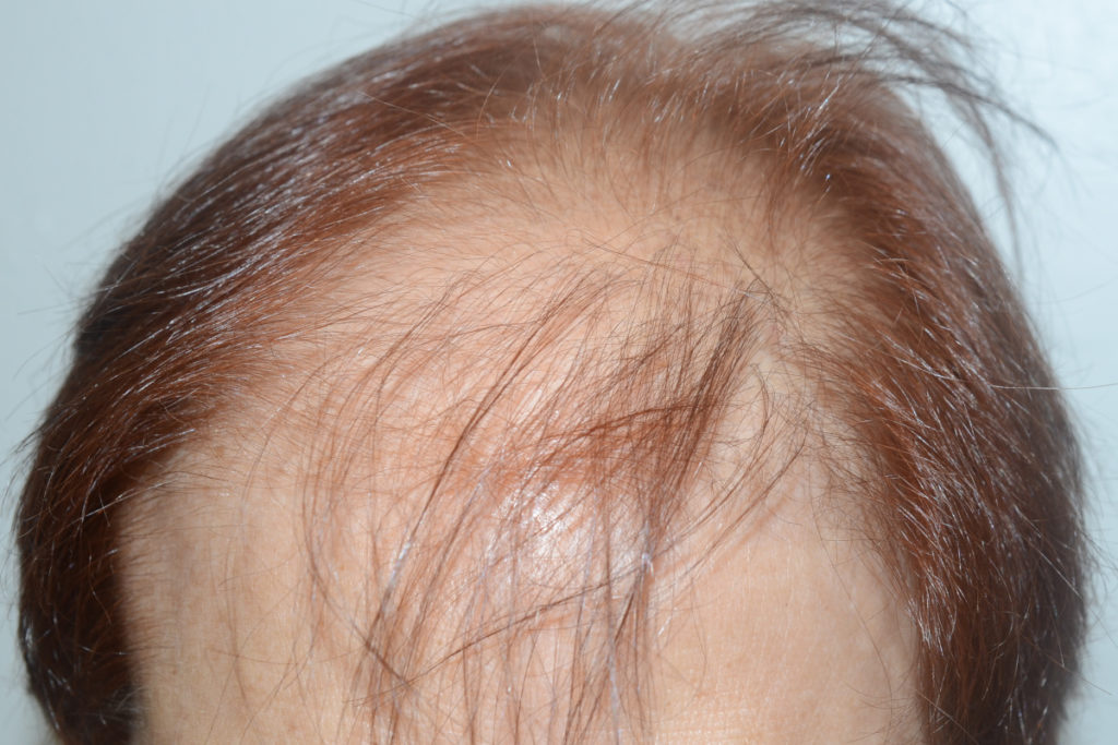 follicular unit micrografting - patient 10661 - before 1
