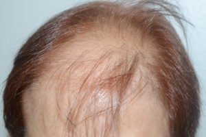  Follicular Unit Micrografting Photo - Patient 1 - Before 1