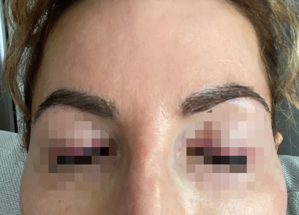 eyebrows transplant - patient 10737 - after 1