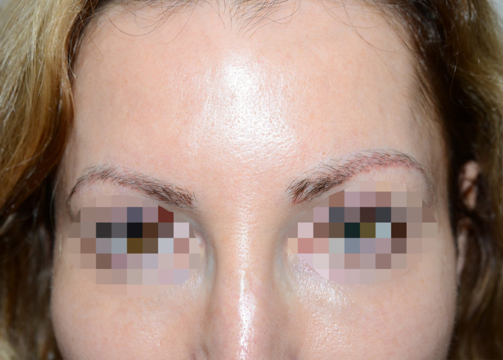 eyebrows transplant - patient 10737 - before 1