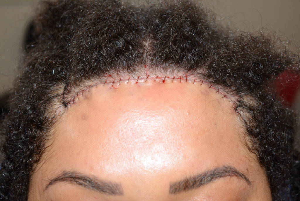 hairline advancement - patient 10741 - after 1