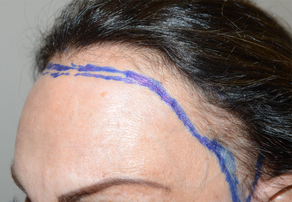 hairline advancement - patient 10755 - before 1