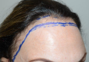  Hairline Advancement Photo - Patient 1 - Before 2