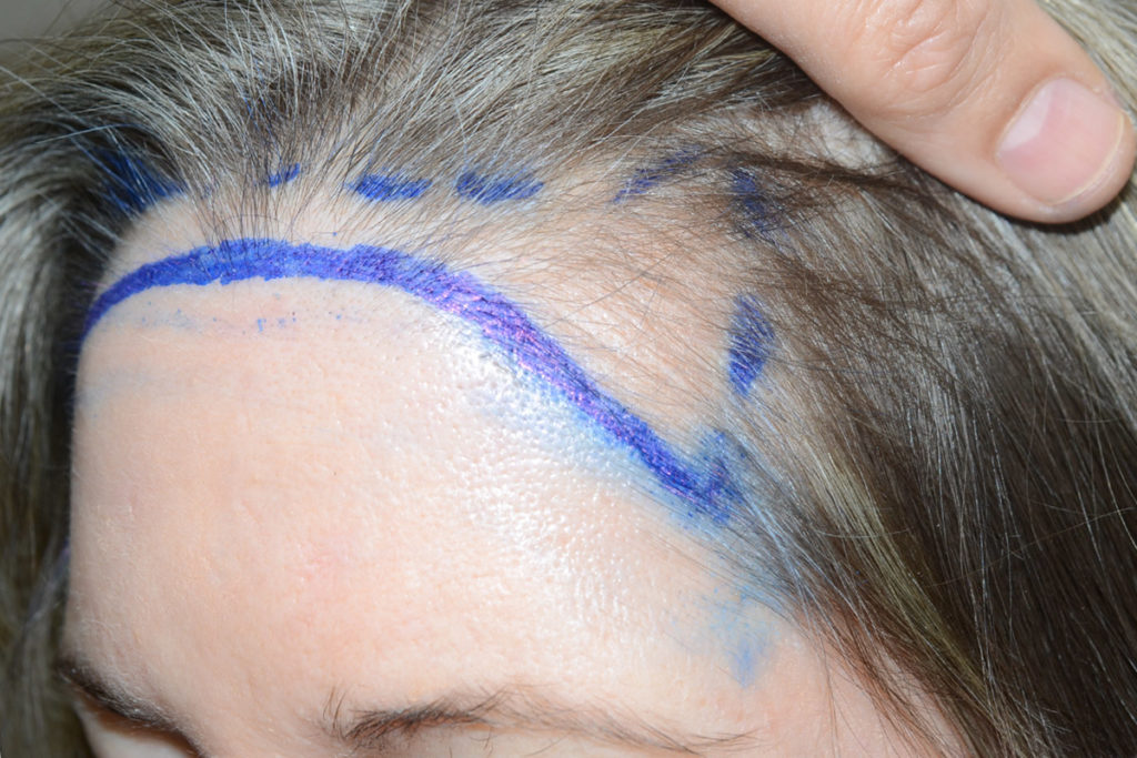 hairline advancement - patient 10817 - before 3
