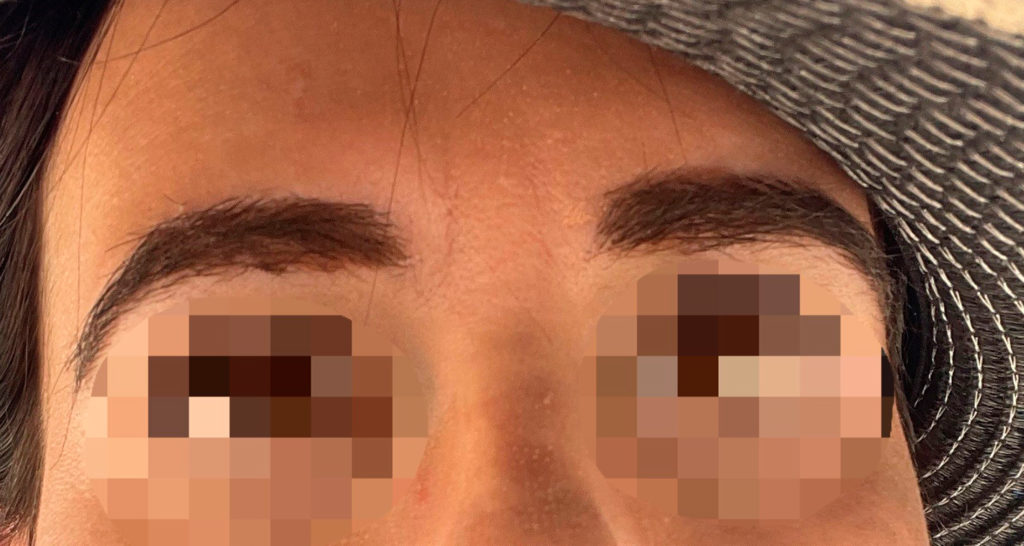 eyebrows transplant - patient 10849 - before 2
