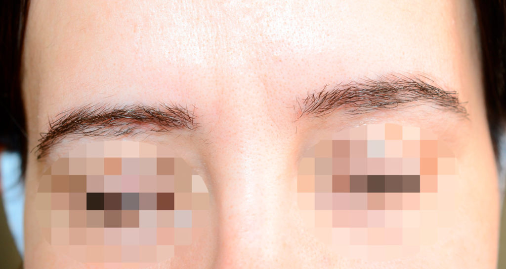 eyebrows transplant - patient 10849 - before 1