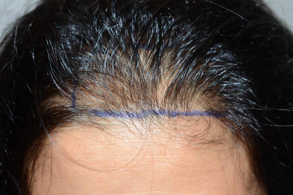 hairline advancement - patient 10864 - before 1