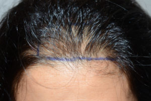 Miami, FL Hairline Advancement Photo - Patient 1 - Before 1